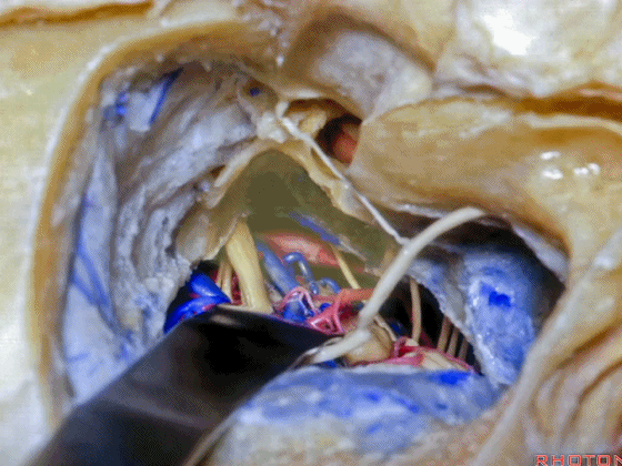 外展枕怎么使用脑干解剖及相关入路---Rhoton解剖视频学习笔记系列_https://www.jmylbn.com_新闻资讯_第288张