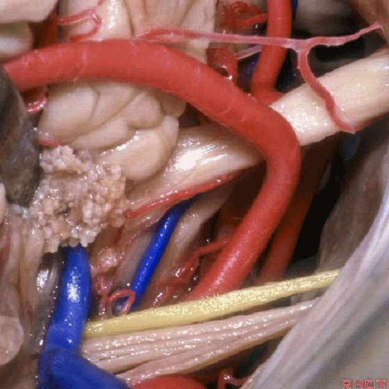 外展枕怎么使用脑干解剖及相关入路---Rhoton解剖视频学习笔记系列_https://www.jmylbn.com_新闻资讯_第272张