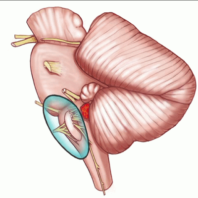 外展枕怎么使用脑干解剖及相关入路---Rhoton解剖视频学习笔记系列_https://www.jmylbn.com_新闻资讯_第161张