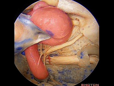 外展枕怎么使用脑干解剖及相关入路---Rhoton解剖视频学习笔记系列_https://www.jmylbn.com_新闻资讯_第348张