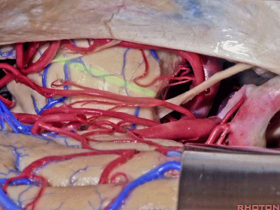 外展枕怎么使用脑干解剖及相关入路---Rhoton解剖视频学习笔记系列_https://www.jmylbn.com_新闻资讯_第173张