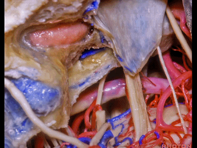 外展枕怎么使用脑干解剖及相关入路---Rhoton解剖视频学习笔记系列_https://www.jmylbn.com_新闻资讯_第302张