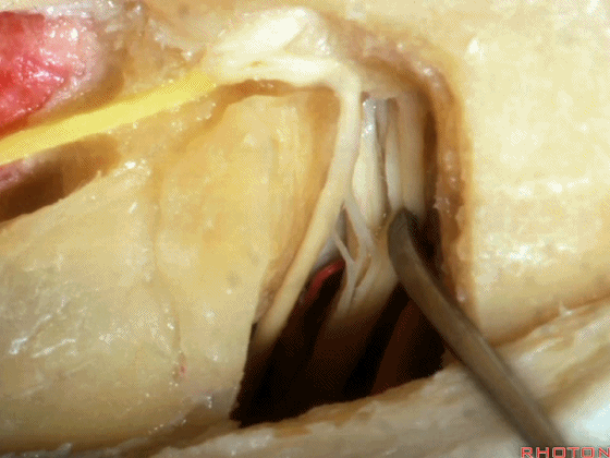 外展枕怎么使用脑干解剖及相关入路---Rhoton解剖视频学习笔记系列_https://www.jmylbn.com_新闻资讯_第190张