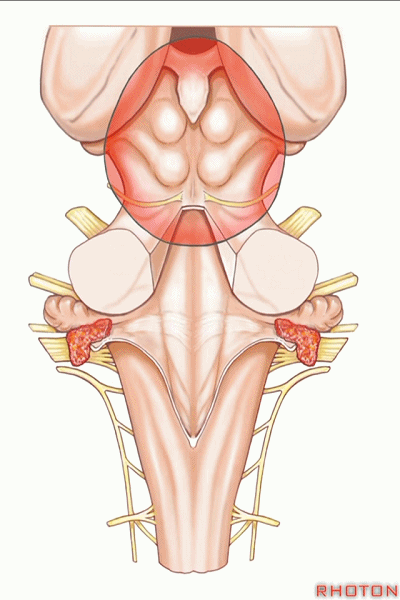 外展枕怎么使用脑干解剖及相关入路---Rhoton解剖视频学习笔记系列_https://www.jmylbn.com_新闻资讯_第74张
