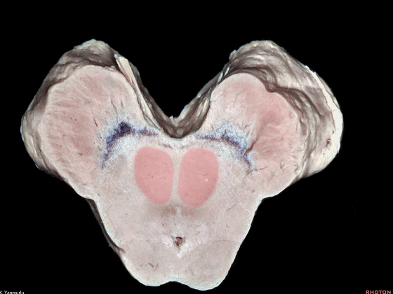 外展枕怎么使用脑干解剖及相关入路---Rhoton解剖视频学习笔记系列_https://www.jmylbn.com_新闻资讯_第72张