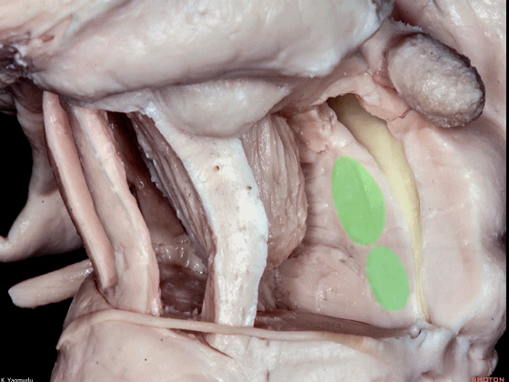 外展枕怎么使用脑干解剖及相关入路---Rhoton解剖视频学习笔记系列_https://www.jmylbn.com_新闻资讯_第84张