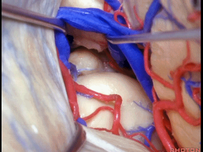 外展枕怎么使用脑干解剖及相关入路---Rhoton解剖视频学习笔记系列_https://www.jmylbn.com_新闻资讯_第227张