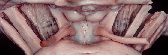 外展枕怎么使用脑干解剖及相关入路---Rhoton解剖视频学习笔记系列_https://www.jmylbn.com_新闻资讯_第50张