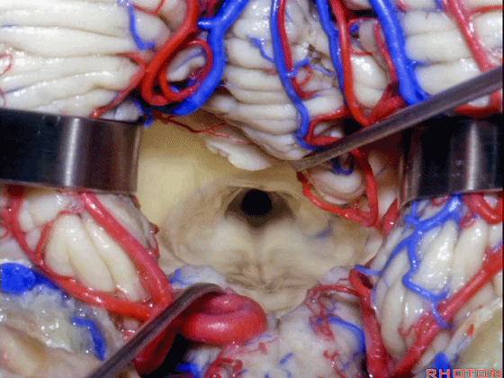 外展枕怎么使用脑干解剖及相关入路---Rhoton解剖视频学习笔记系列_https://www.jmylbn.com_新闻资讯_第249张