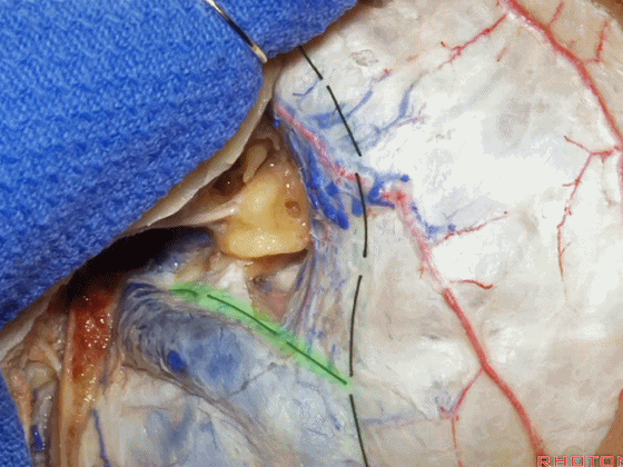 外展枕怎么使用脑干解剖及相关入路---Rhoton解剖视频学习笔记系列_https://www.jmylbn.com_新闻资讯_第296张