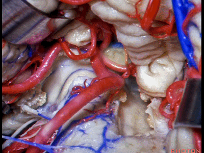 外展枕怎么使用脑干解剖及相关入路---Rhoton解剖视频学习笔记系列_https://www.jmylbn.com_新闻资讯_第260张