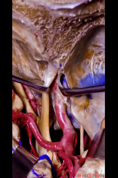 外展枕怎么使用脑干解剖及相关入路---Rhoton解剖视频学习笔记系列_https://www.jmylbn.com_新闻资讯_第202张