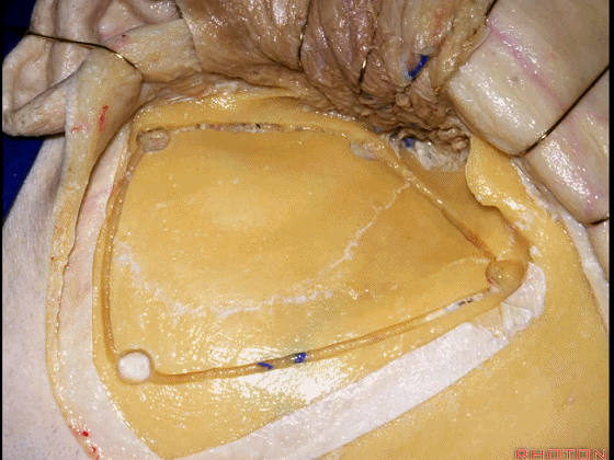 外展枕怎么使用脑干解剖及相关入路---Rhoton解剖视频学习笔记系列_https://www.jmylbn.com_新闻资讯_第170张