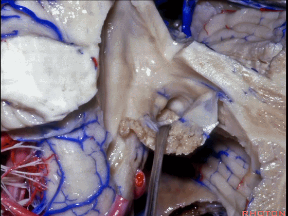 外展枕怎么使用脑干解剖及相关入路---Rhoton解剖视频学习笔记系列_https://www.jmylbn.com_新闻资讯_第251张