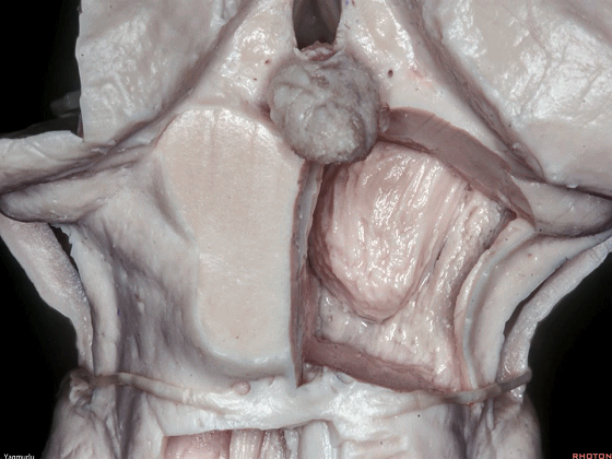 外展枕怎么使用脑干解剖及相关入路---Rhoton解剖视频学习笔记系列_https://www.jmylbn.com_新闻资讯_第78张