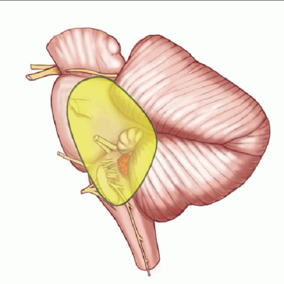 外展枕怎么使用脑干解剖及相关入路---Rhoton解剖视频学习笔记系列_https://www.jmylbn.com_新闻资讯_第266张