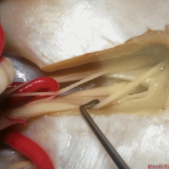 外展枕怎么使用脑干解剖及相关入路---Rhoton解剖视频学习笔记系列_https://www.jmylbn.com_新闻资讯_第275张