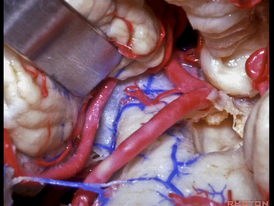 外展枕怎么使用脑干解剖及相关入路---Rhoton解剖视频学习笔记系列_https://www.jmylbn.com_新闻资讯_第255张