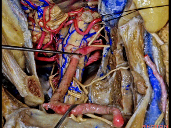 外展枕怎么使用脑干解剖及相关入路---Rhoton解剖视频学习笔记系列_https://www.jmylbn.com_新闻资讯_第322张