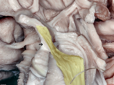 外展枕怎么使用脑干解剖及相关入路---Rhoton解剖视频学习笔记系列_https://www.jmylbn.com_新闻资讯_第52张