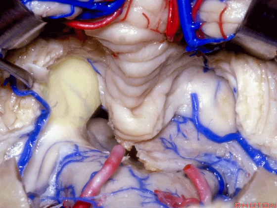 外展枕怎么使用脑干解剖及相关入路---Rhoton解剖视频学习笔记系列_https://www.jmylbn.com_新闻资讯_第264张