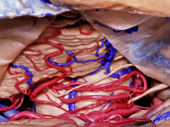 外展枕怎么使用脑干解剖及相关入路---Rhoton解剖视频学习笔记系列_https://www.jmylbn.com_新闻资讯_第178张