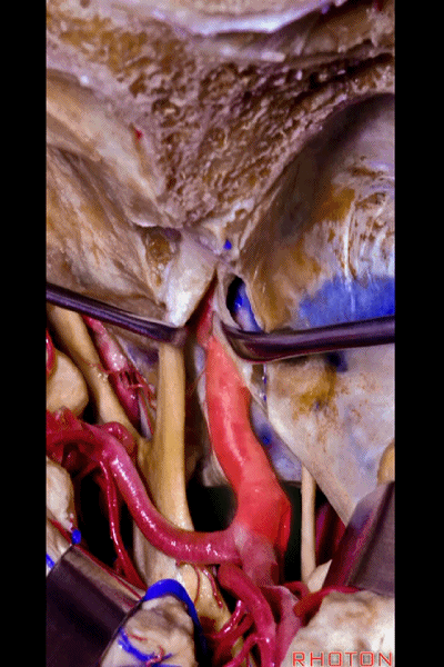 外展枕怎么使用脑干解剖及相关入路---Rhoton解剖视频学习笔记系列_https://www.jmylbn.com_新闻资讯_第203张