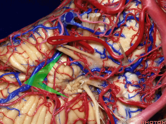 外展枕怎么使用脑干解剖及相关入路---Rhoton解剖视频学习笔记系列_https://www.jmylbn.com_新闻资讯_第269张