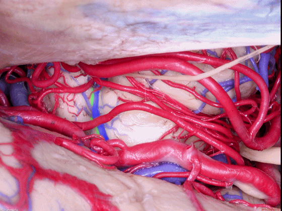 外展枕怎么使用脑干解剖及相关入路---Rhoton解剖视频学习笔记系列_https://www.jmylbn.com_新闻资讯_第59张