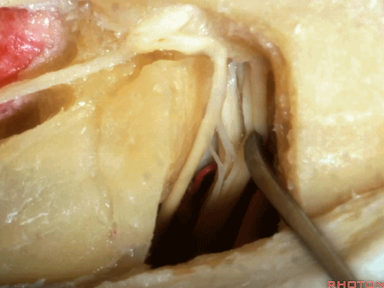 外展枕怎么使用脑干解剖及相关入路---Rhoton解剖视频学习笔记系列_https://www.jmylbn.com_新闻资讯_第189张