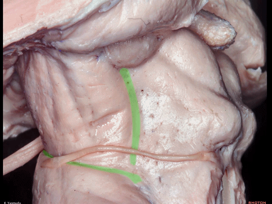 外展枕怎么使用脑干解剖及相关入路---Rhoton解剖视频学习笔记系列_https://www.jmylbn.com_新闻资讯_第64张