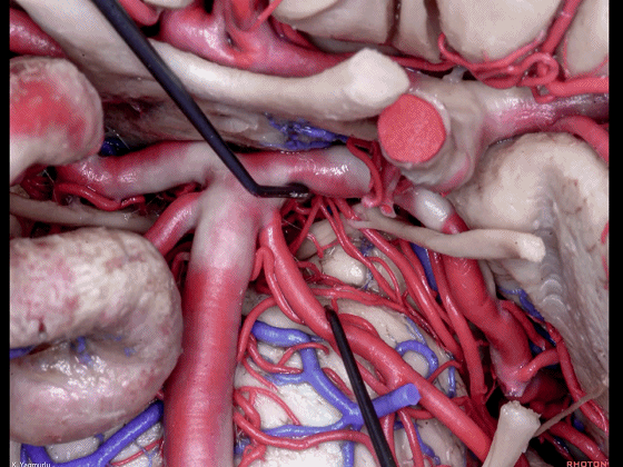 外展枕怎么使用脑干解剖及相关入路---Rhoton解剖视频学习笔记系列_https://www.jmylbn.com_新闻资讯_第42张