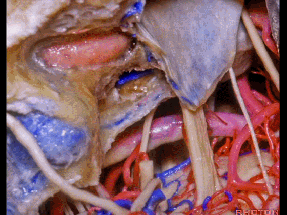 外展枕怎么使用脑干解剖及相关入路---Rhoton解剖视频学习笔记系列_https://www.jmylbn.com_新闻资讯_第300张