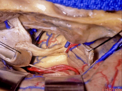 外展枕怎么使用脑干解剖及相关入路---Rhoton解剖视频学习笔记系列_https://www.jmylbn.com_新闻资讯_第195张