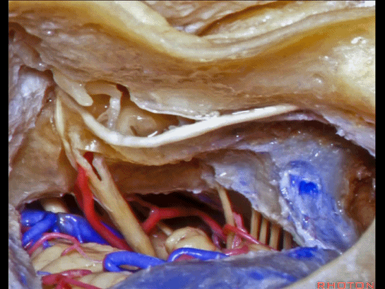 外展枕怎么使用脑干解剖及相关入路---Rhoton解剖视频学习笔记系列_https://www.jmylbn.com_新闻资讯_第285张