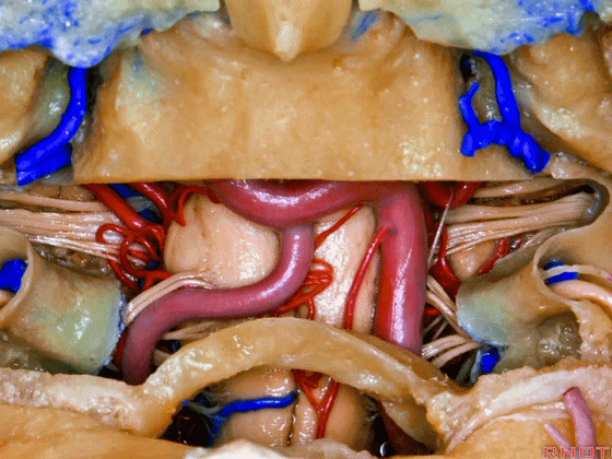 外展枕怎么使用脑干解剖及相关入路---Rhoton解剖视频学习笔记系列_https://www.jmylbn.com_新闻资讯_第337张