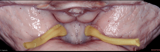 外展枕怎么使用脑干解剖及相关入路---Rhoton解剖视频学习笔记系列_https://www.jmylbn.com_新闻资讯_第48张