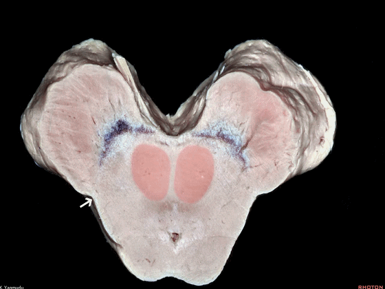 外展枕怎么使用脑干解剖及相关入路---Rhoton解剖视频学习笔记系列_https://www.jmylbn.com_新闻资讯_第70张