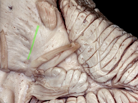 外展枕怎么使用脑干解剖及相关入路---Rhoton解剖视频学习笔记系列_https://www.jmylbn.com_新闻资讯_第98张