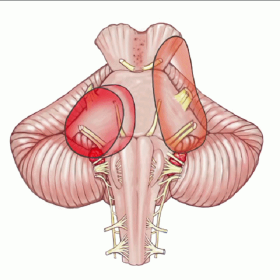 外展枕怎么使用脑干解剖及相关入路---Rhoton解剖视频学习笔记系列_https://www.jmylbn.com_新闻资讯_第153张