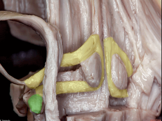 外展枕怎么使用脑干解剖及相关入路---Rhoton解剖视频学习笔记系列_https://www.jmylbn.com_新闻资讯_第112张