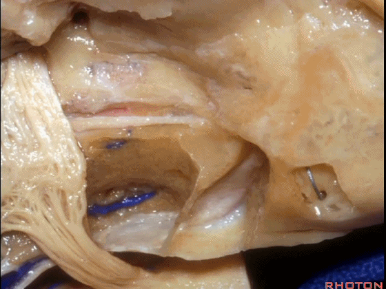 外展枕怎么使用脑干解剖及相关入路---Rhoton解剖视频学习笔记系列_https://www.jmylbn.com_新闻资讯_第188张