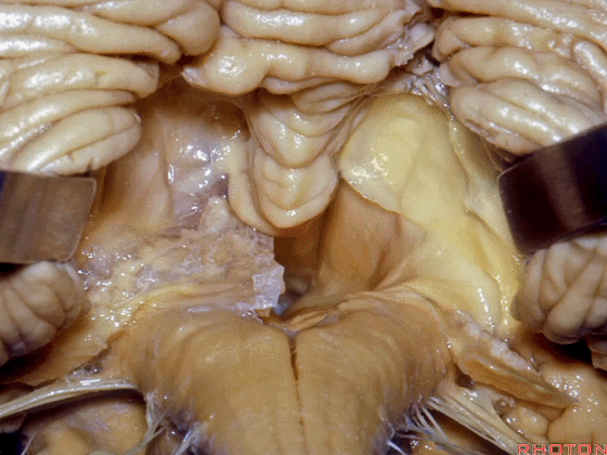 外展枕怎么使用脑干解剖及相关入路---Rhoton解剖视频学习笔记系列_https://www.jmylbn.com_新闻资讯_第238张