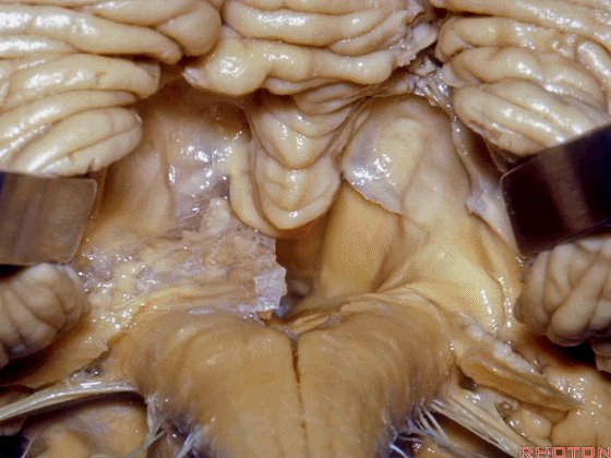 外展枕怎么使用脑干解剖及相关入路---Rhoton解剖视频学习笔记系列_https://www.jmylbn.com_新闻资讯_第241张