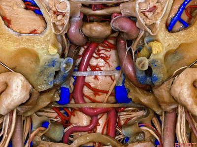 外展枕怎么使用脑干解剖及相关入路---Rhoton解剖视频学习笔记系列_https://www.jmylbn.com_新闻资讯_第357张