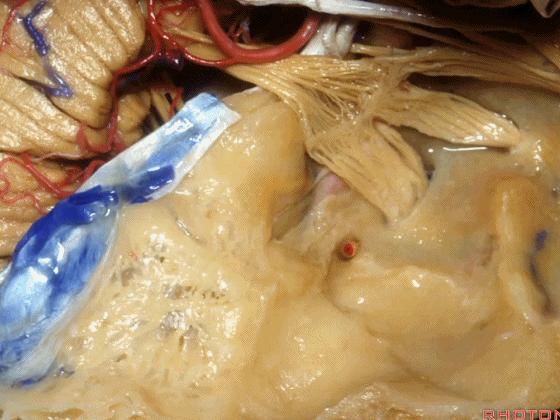 外展枕怎么使用脑干解剖及相关入路---Rhoton解剖视频学习笔记系列_https://www.jmylbn.com_新闻资讯_第182张