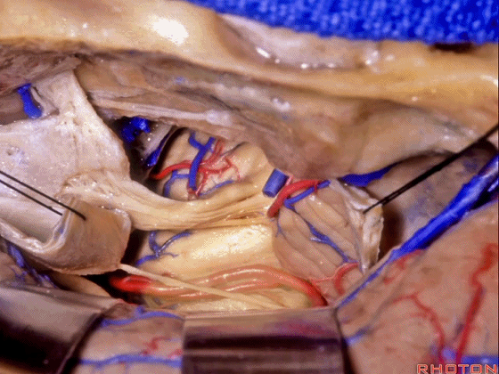 外展枕怎么使用脑干解剖及相关入路---Rhoton解剖视频学习笔记系列_https://www.jmylbn.com_新闻资讯_第194张