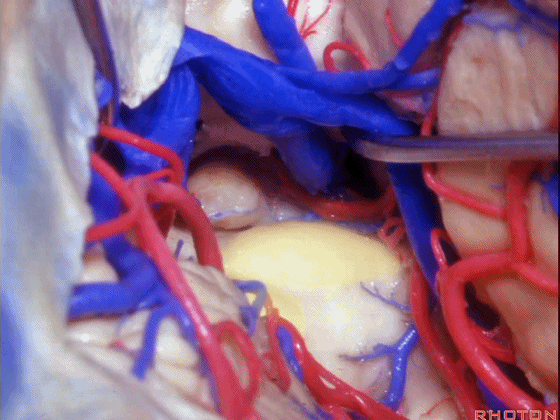 外展枕怎么使用脑干解剖及相关入路---Rhoton解剖视频学习笔记系列_https://www.jmylbn.com_新闻资讯_第229张