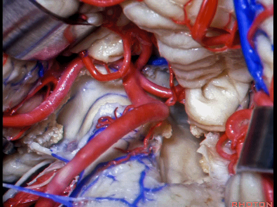 外展枕怎么使用脑干解剖及相关入路---Rhoton解剖视频学习笔记系列_https://www.jmylbn.com_新闻资讯_第258张