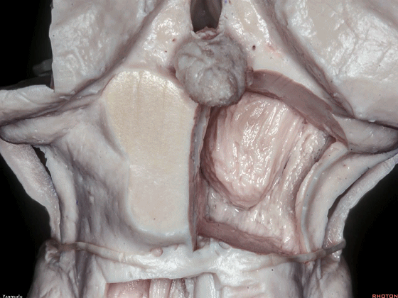 外展枕怎么使用脑干解剖及相关入路---Rhoton解剖视频学习笔记系列_https://www.jmylbn.com_新闻资讯_第77张